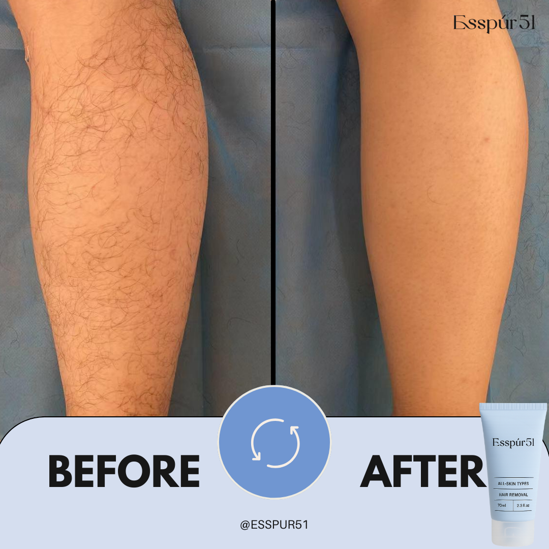 SET C - Removal Cream x3 + Aloe Vera x2