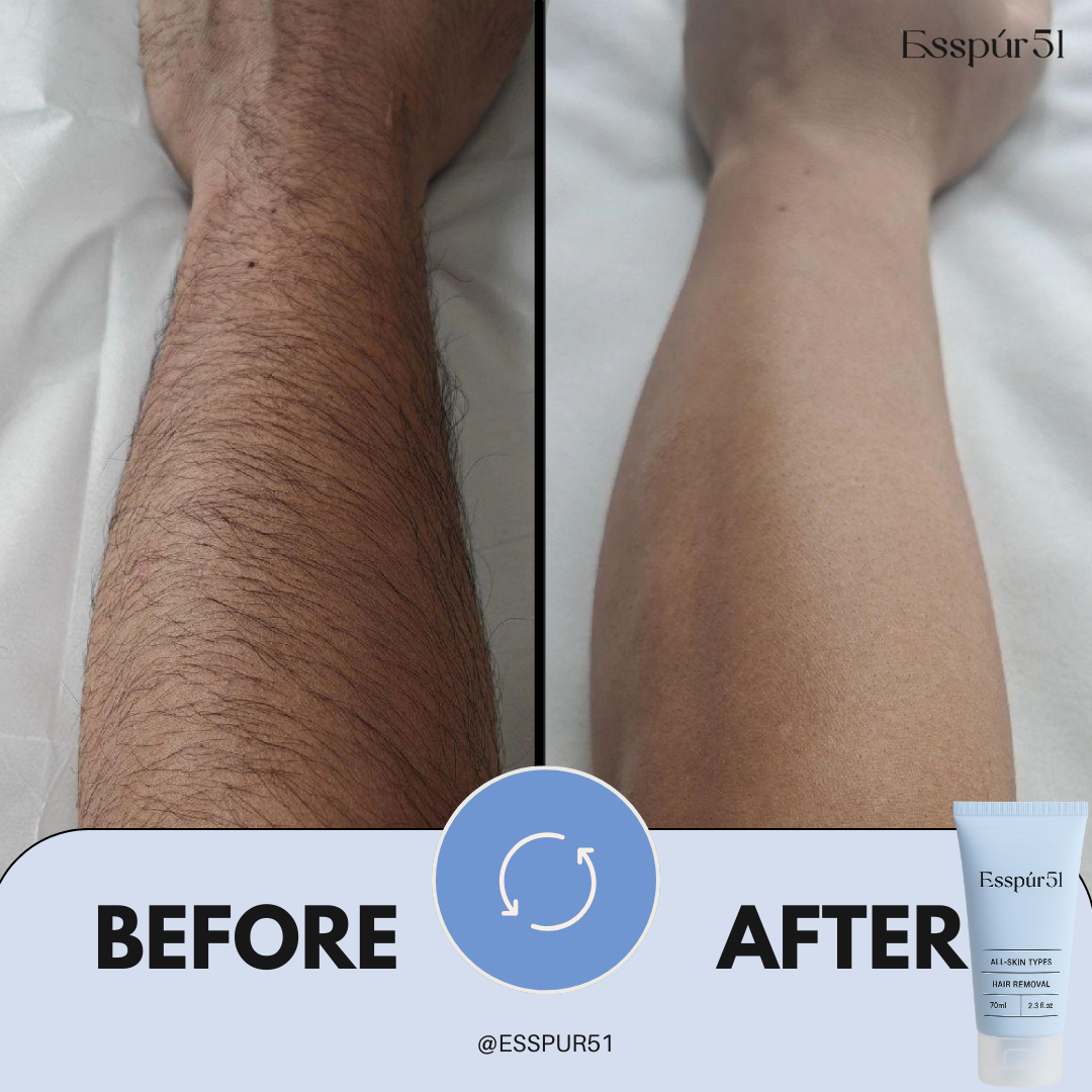 SET C - Removal Cream x3 + Aloe Vera x2
